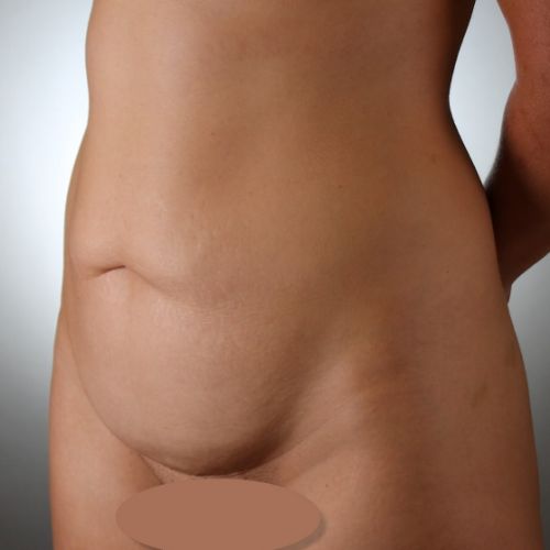 Tummy Tuck