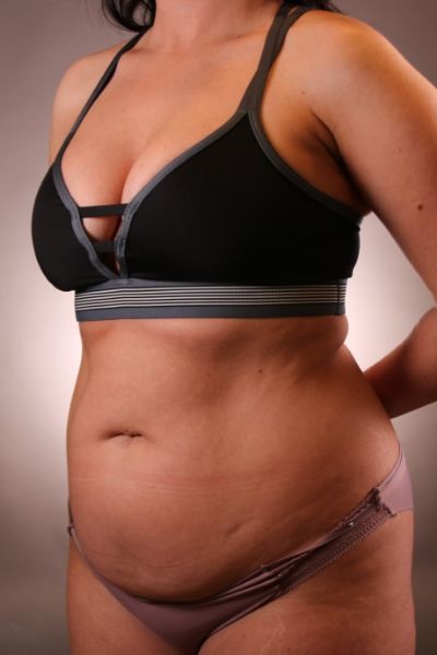 Tummy Tuck