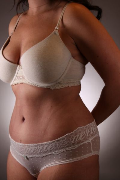 Tummy Tuck