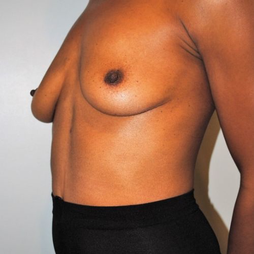 Breast Augmentation