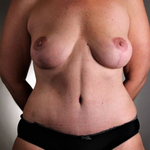 Tummy Tuck