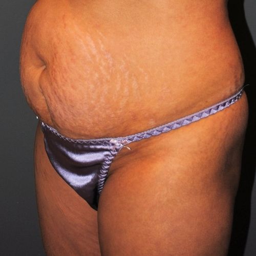 Tummy Tuck