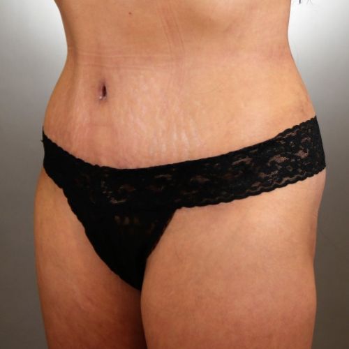 Tummy Tuck