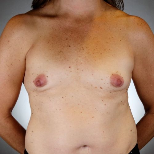 Breast Augmentation