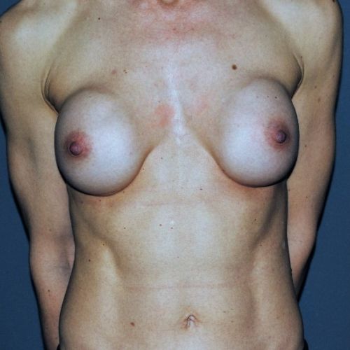 Breast Revision