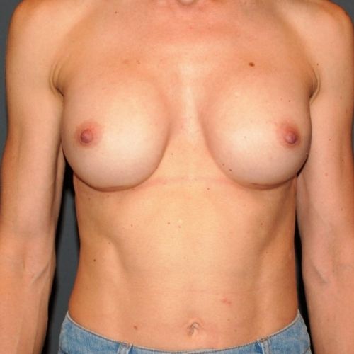 Breast Revision