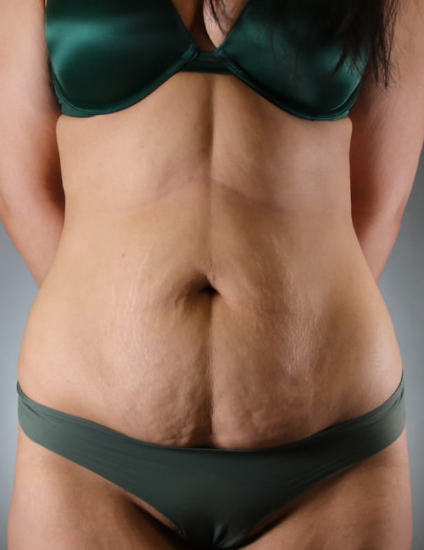 Tummy Tuck