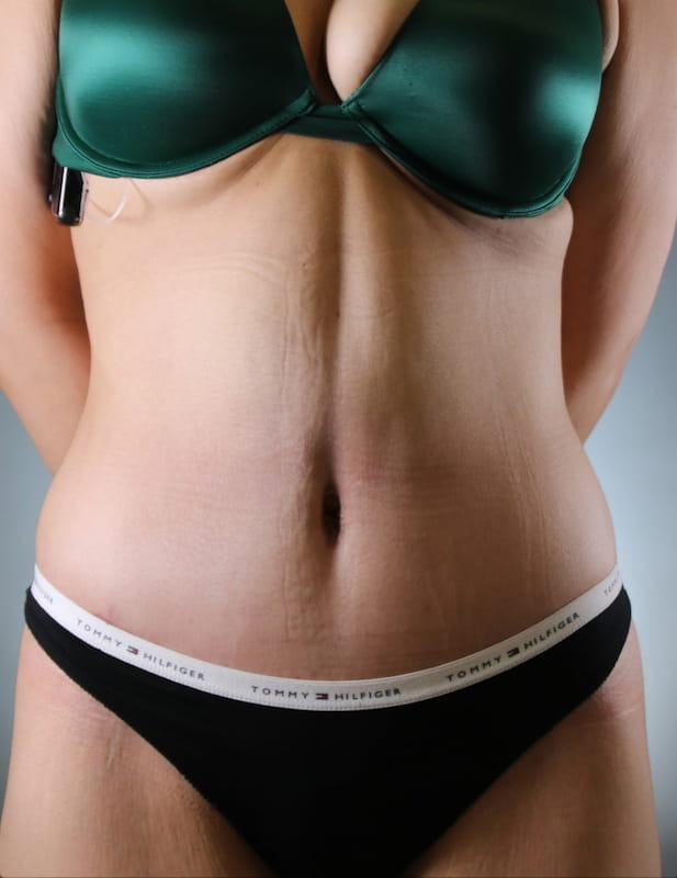 Tummy Tuck