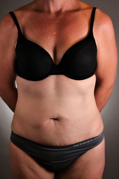 Tummy Tuck