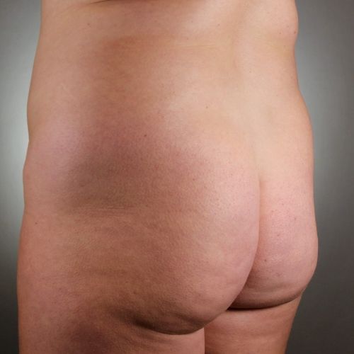 Liposuction