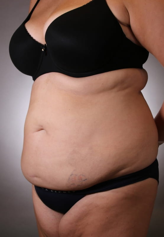 Tummy Tuck