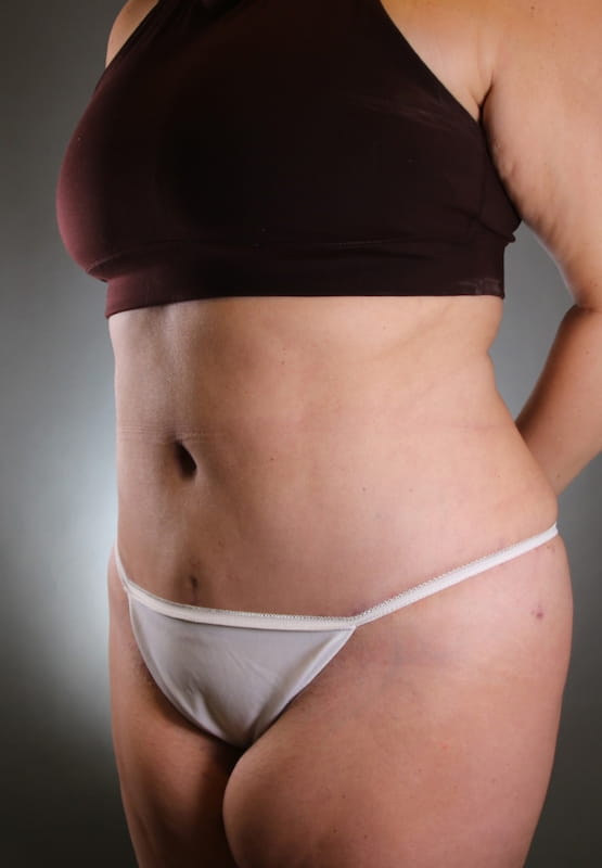 Tummy Tuck