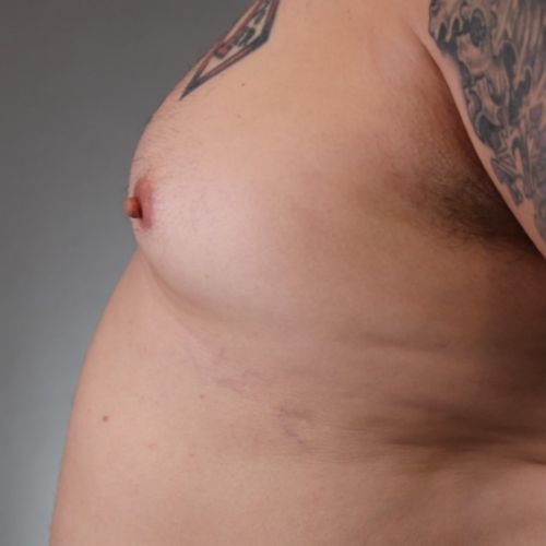 Gynecomastia Surgery