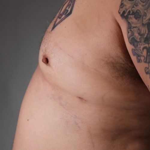 Gynecomastia Surgery