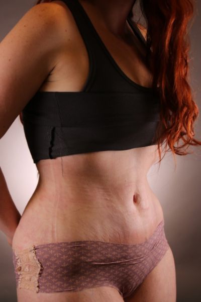 Tummy Tuck