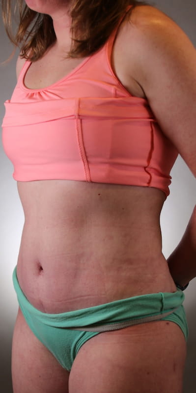 Tummy Tuck