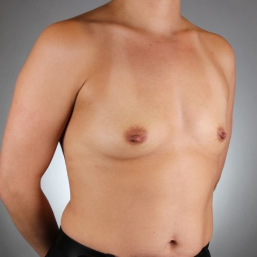 Breast Augmentation