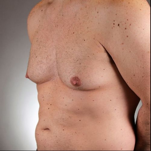 Gynecomastia Surgery