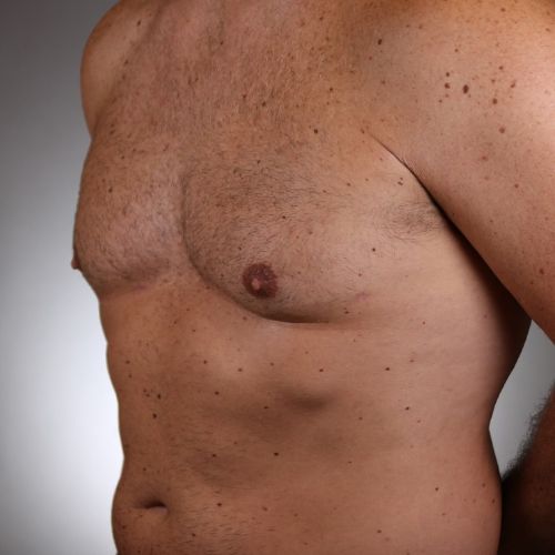 Gynecomastia Surgery