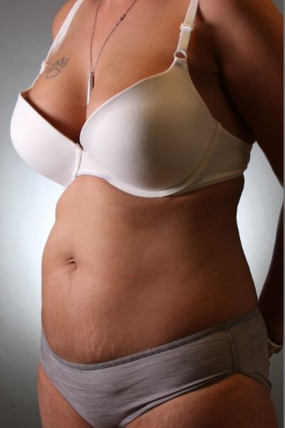 Tummy Tuck