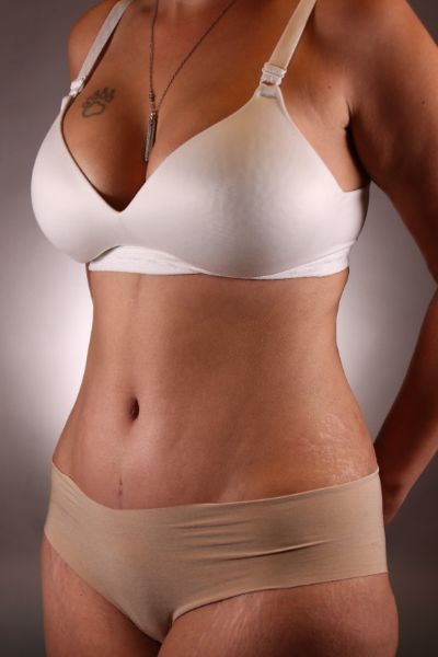 Tummy Tuck