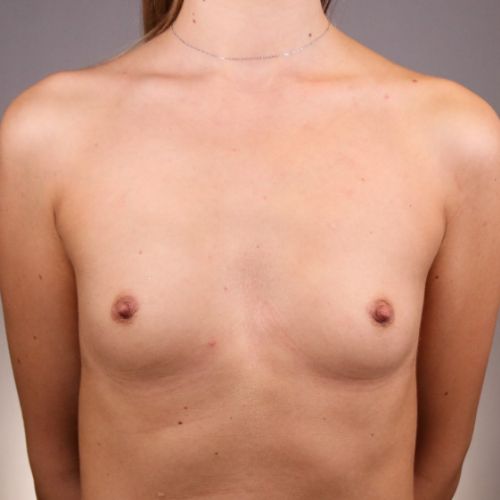 Breast Augmentation