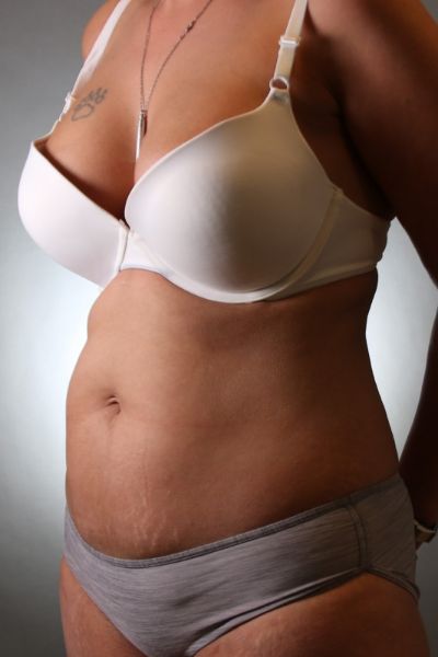 Tummy Tuck