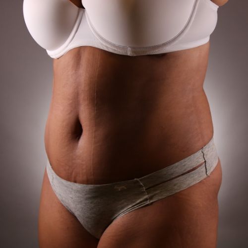 Tummy Tuck