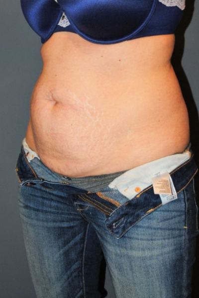 Tummy Tuck