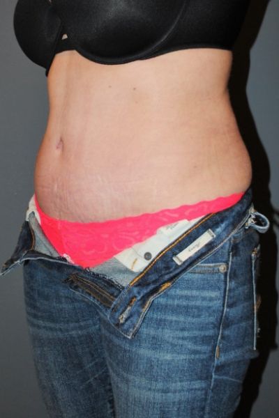 Tummy Tuck