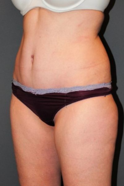 Tummy Tuck