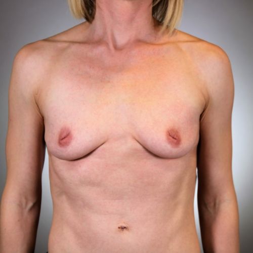 Breast Augmentation