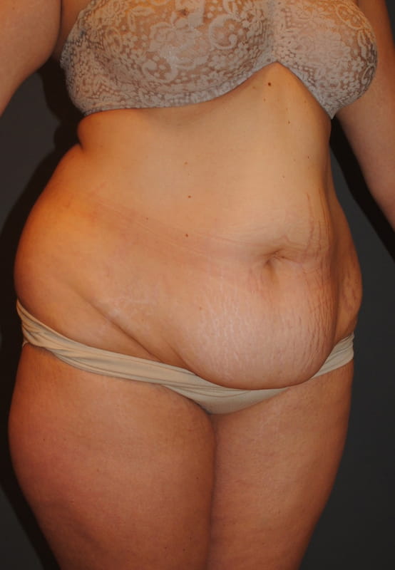 Tummy Tuck