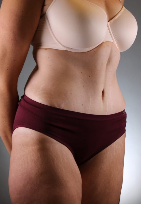 Tummy Tuck