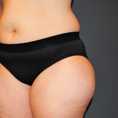 Liposuction