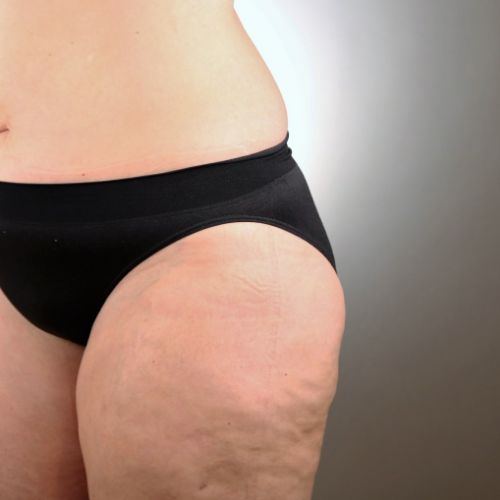 Liposuction