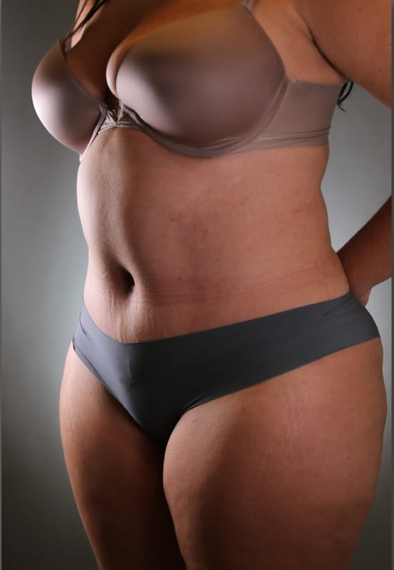 Tummy Tuck