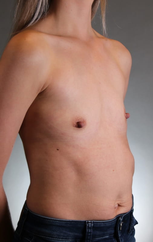 Breast Augmentation