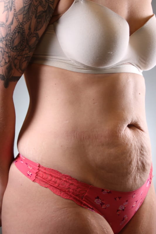 Tummy Tuck