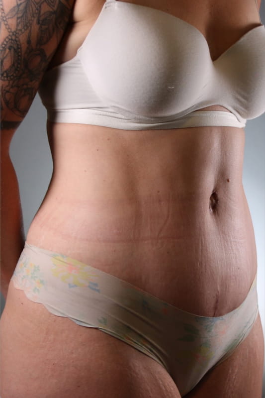 Tummy Tuck