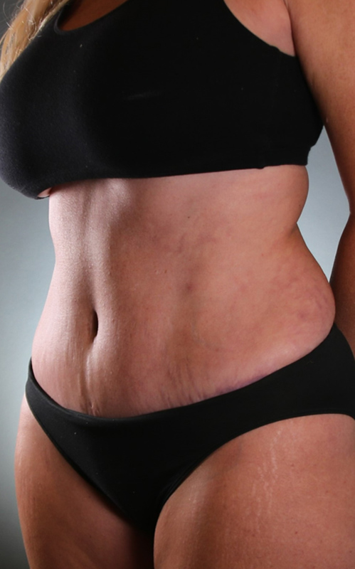 Tummy Tuck