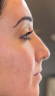 Liquid Rhinoplasty