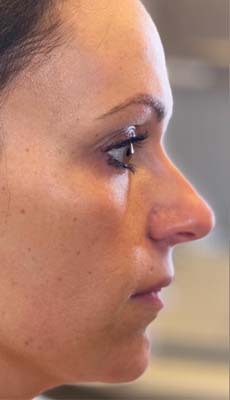 Liquid Rhinoplasty