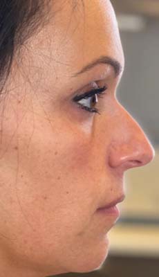 Liquid Rhinoplasty