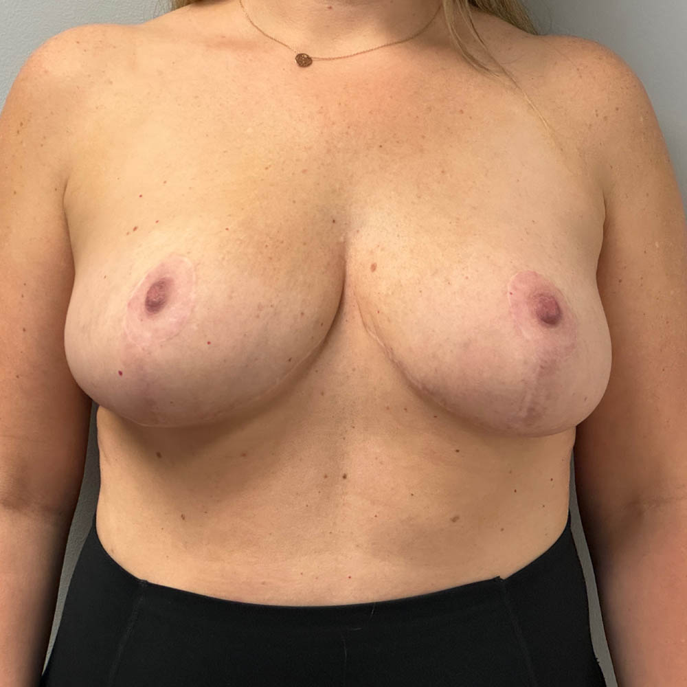 1_0001_breastredu (1).jpg