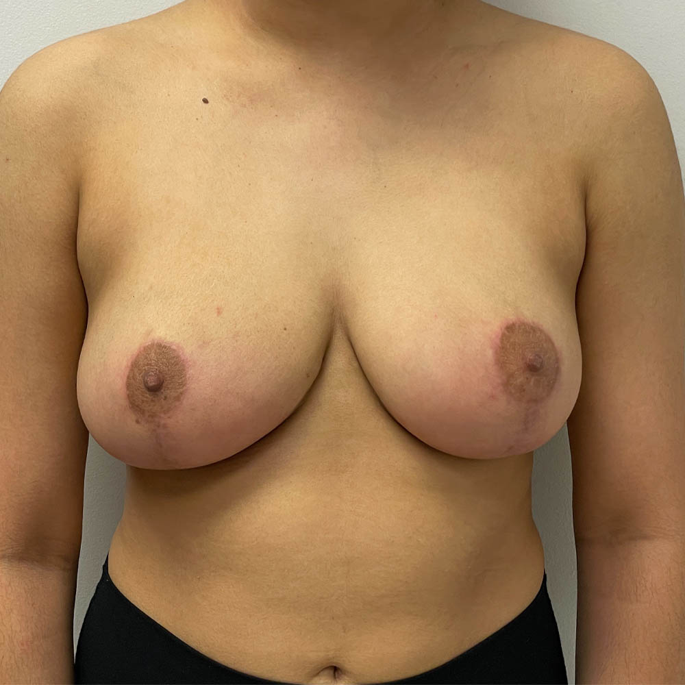 1_0003_breastredu (4).jpg