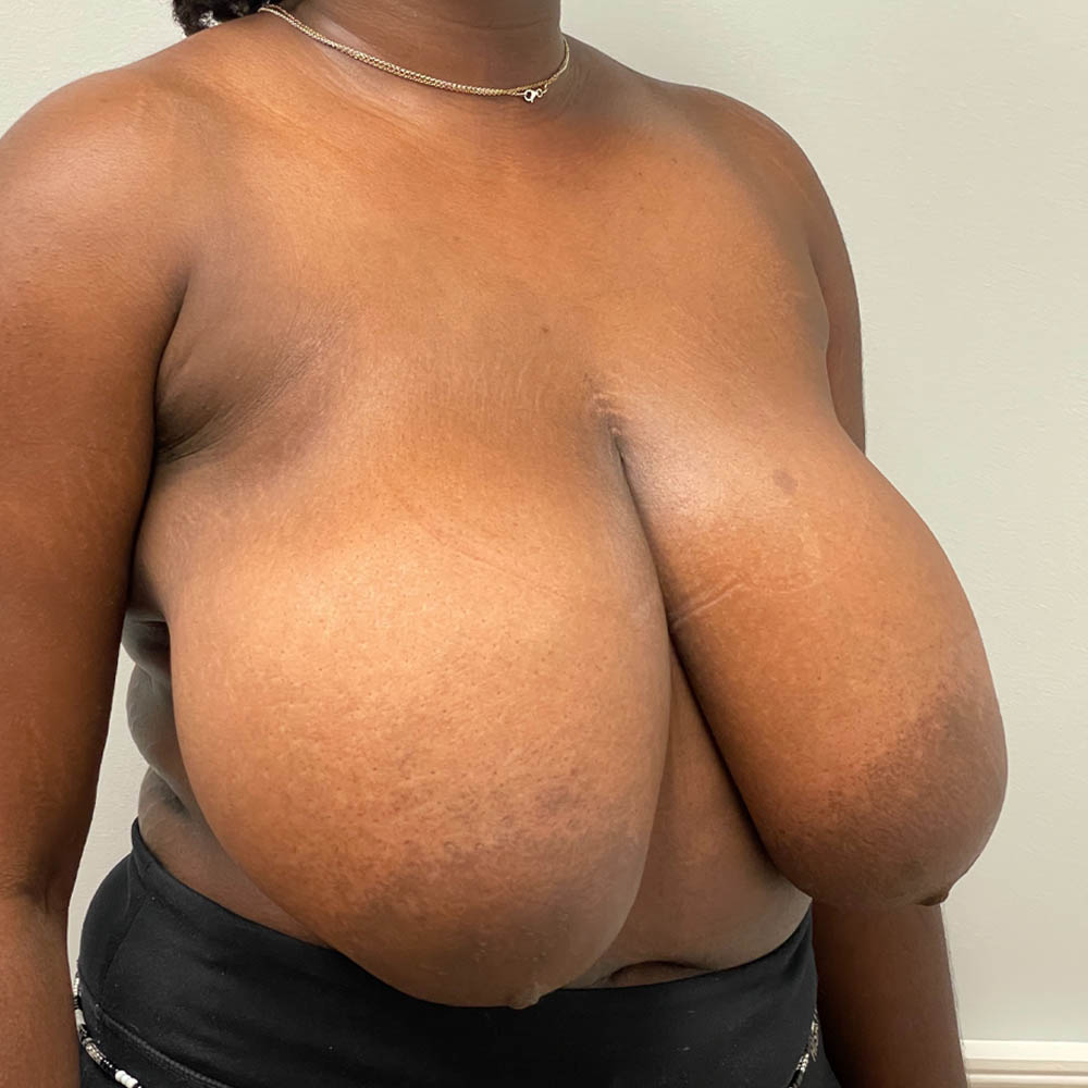 1_0008_breastredu (9).jpg